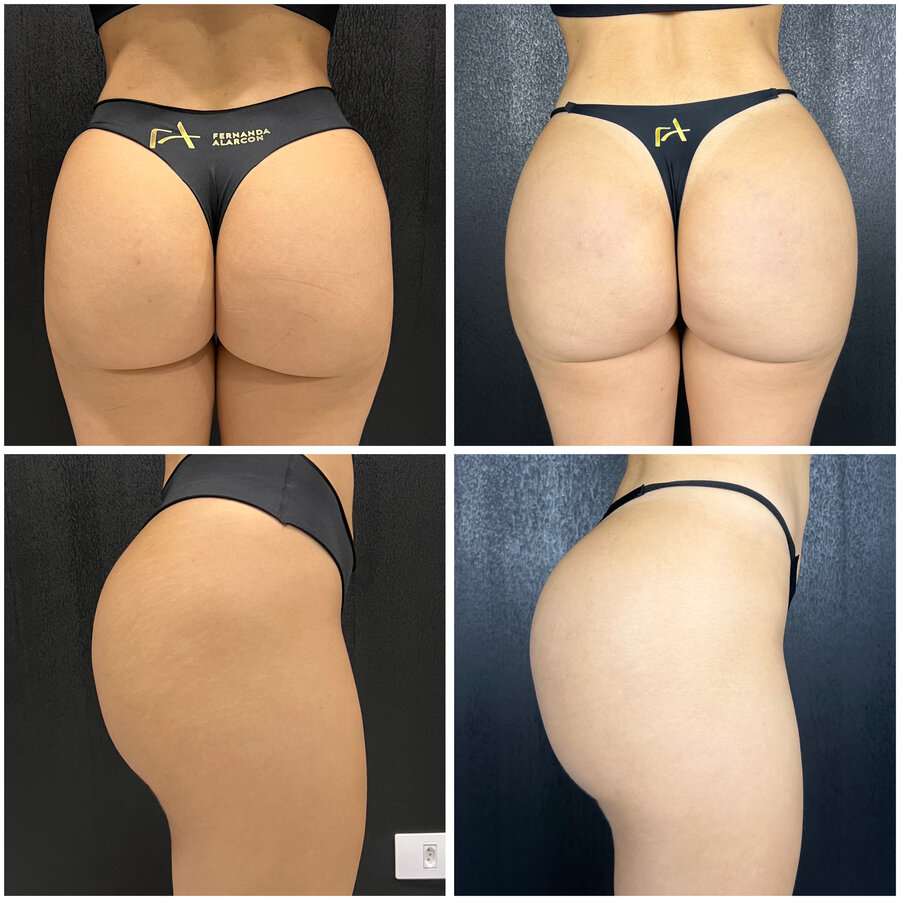 Resultado Antes e Depois - Caso 2 - Método BBS Dra. Fernanda Alarcon