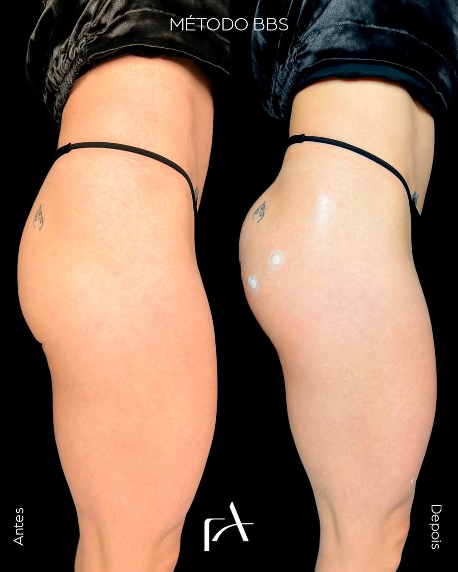 Resultado Antes e Depois - Caso 3 - Método BBS Dra. Fernanda Alarcon
